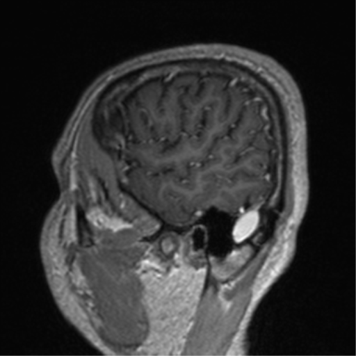 File:Cerebral venous thrombosis (Radiopaedia 38392-40469 Sagittal T1 C+ 75).png