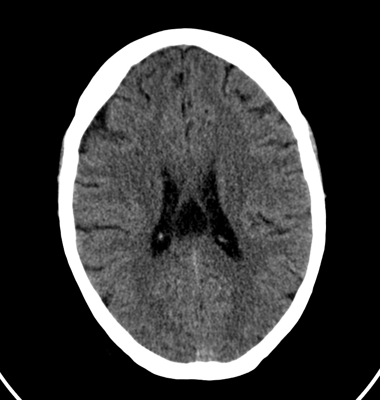 Cerebral venous thrombosis - CT only (Radiopaedia 41031-43778 Axial non-contrast 32).jpg