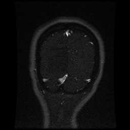 Cerebral venous thrombosis - ulcerative colitis (Radiopaedia 66049-75219 Coronal MRV 18).jpg