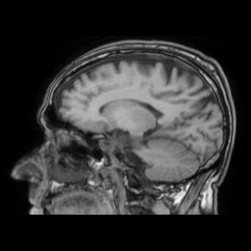 File:Cerebral venous thrombosis with secondary intracranial hypertension (Radiopaedia 89842-106957 Sagittal T1 13).jpg