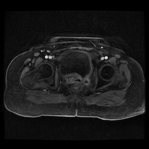 Cervical carcinoma (Radiopaedia 70924-81132 Axial T1 C+ fat sat 39).jpg