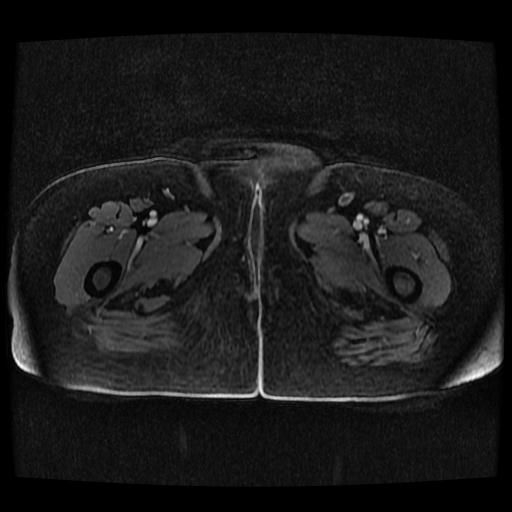 File:Cervical carcinoma (Radiopaedia 70924-81132 Axial T1 C+ fat sat 99).jpg