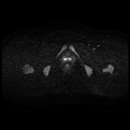 Cervical carcinoma (Radiopaedia 88010-104555 Axial DWI 41).jpg