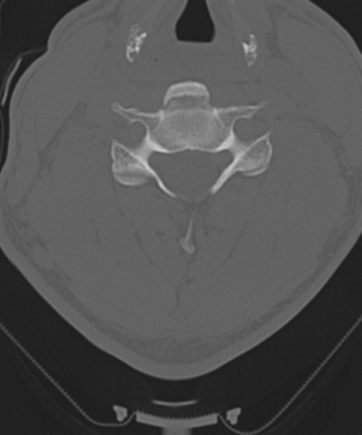 Cervical intercalary bone (Radiopaedia 35211-36748 Axial bone window 36).png