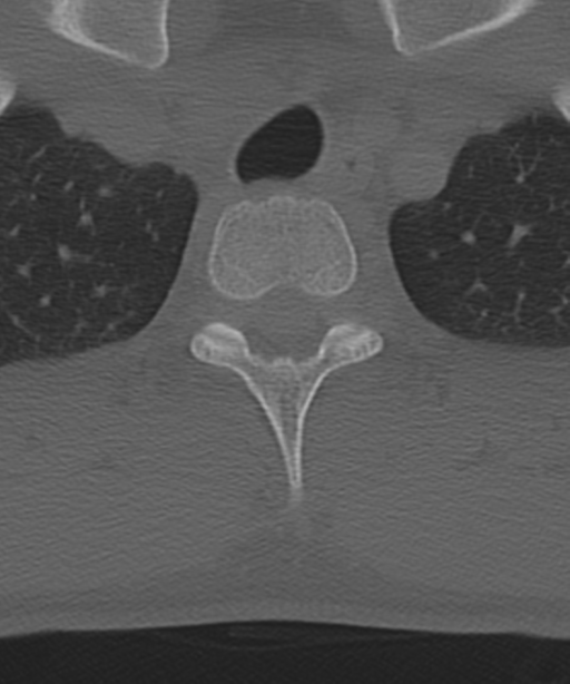 Cervical intercalary bone (Radiopaedia 35211-36748 Axial bone window 67).png