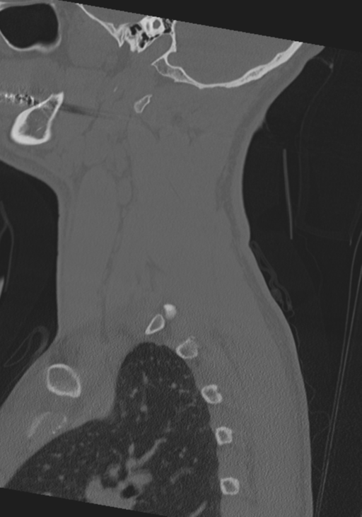 Cervical intercalary bone (Radiopaedia 35211-36748 Sagittal bone window 66).png