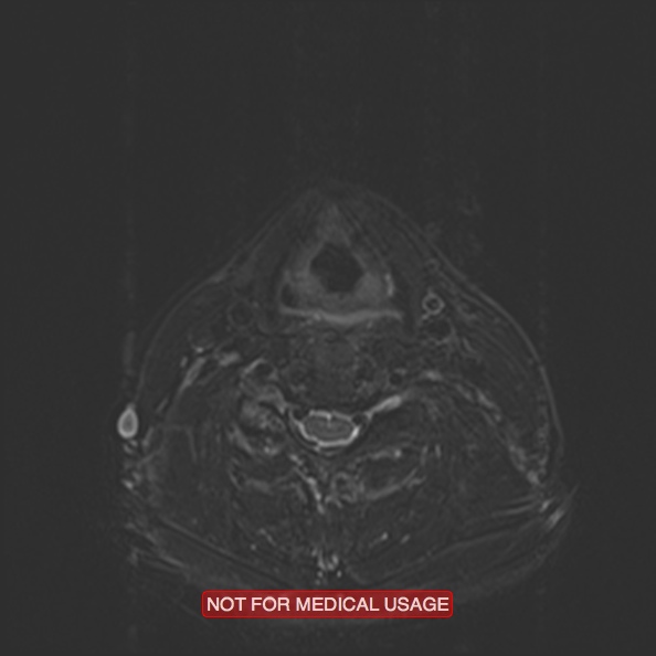 Cervical nerve schwannoma (Radiopaedia 27964-28221 C 36).jpg