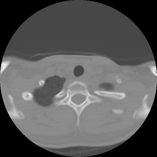 Cervical rib (Radiopaedia 71110-81363 Axial non-contrast 48).jpg