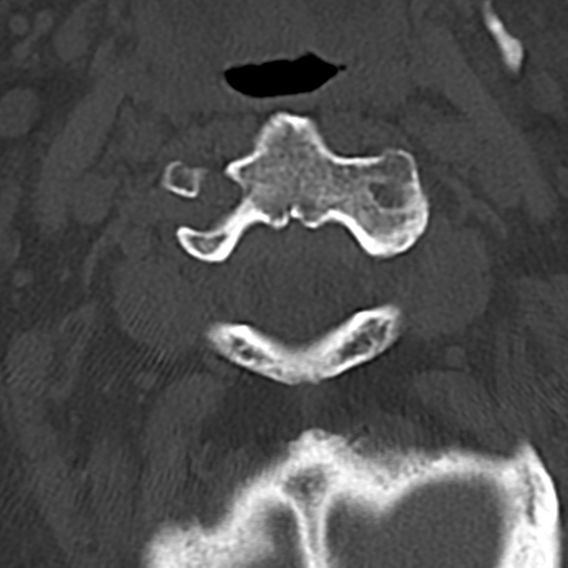 File:Cervical spine fracture - chalk stick (Radiopaedia 39116-41323 Axial bone window 22).png
