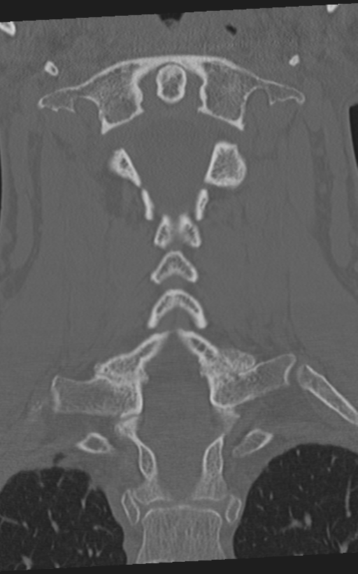 Cervical spine fractures with vertebral artery dissection (Radiopaedia 53296-59268 Coronal bone window 39).png