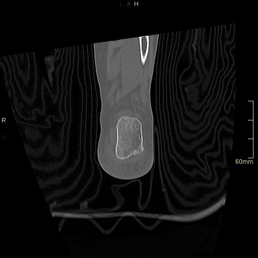 Chaput tubercle fracture (Radiopaedia 80319-93956 Coronal non-contrast 53).jpg
