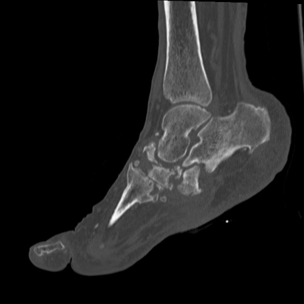 Charcot joint (Radiopaedia 36629-38194 Sagittal bone window 51).jpg
