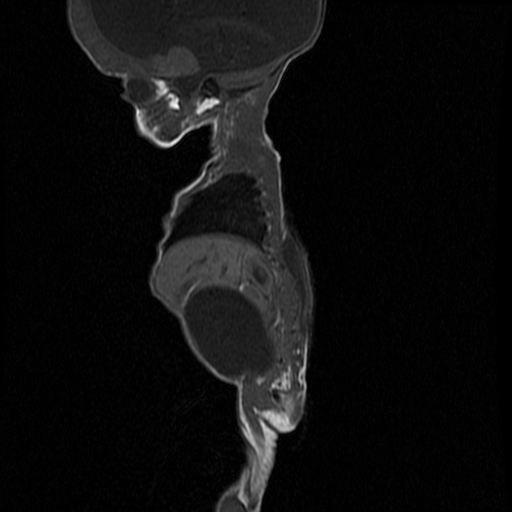 File:Chiari II malformation with spinal meningomyelocele (Radiopaedia 23550-23652 Sagittal T1 9).jpg