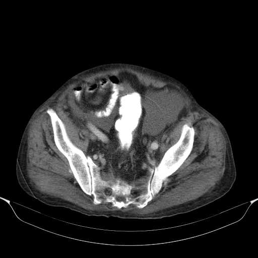 File:Cholangitis and abscess formation in a patient with cholangiocarcinoma (Radiopaedia 21194-21100 A 42).jpg