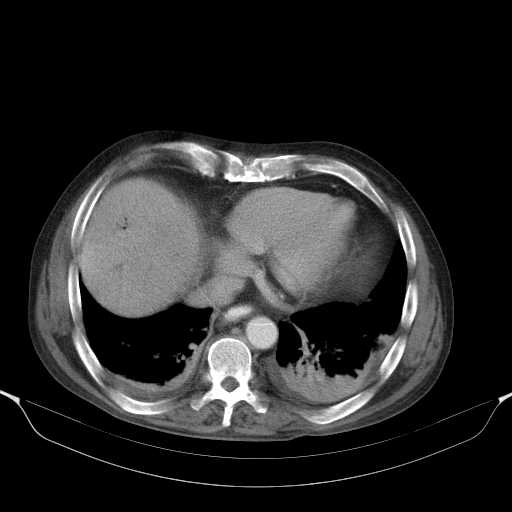 File:Cholangitis and abscess formation in a patient with cholangiocarcinoma (Radiopaedia 21194-21100 A 7).jpg