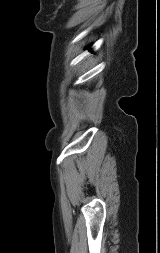 Cholecystoduodenal fistula due to calculous cholecystitis with gallstone migration (Radiopaedia 86875-103077 C 58).jpg