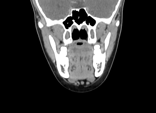 File:Chondroblastic osteosarcoma (Radiopaedia 67363-76741 D 50).jpg