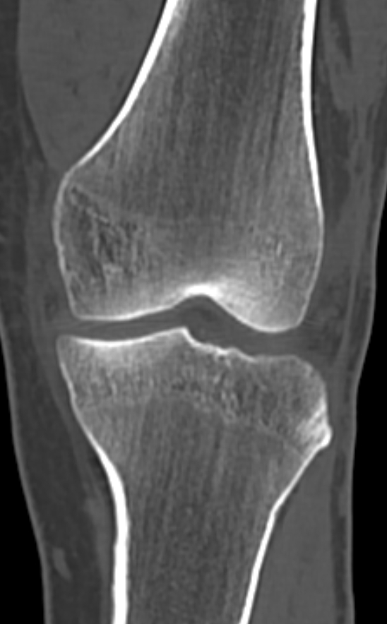 Chondrocalcinosis (Radiopaedia 82862-97173 Coronal bone window 34).jpg