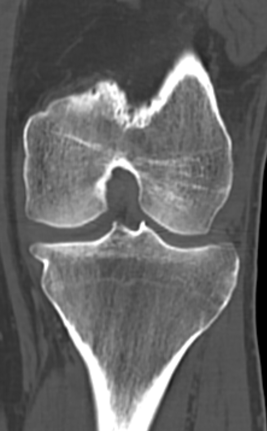 Chondrocalcinosis (Radiopaedia 82862-97173 Coronal bone window 48).jpg