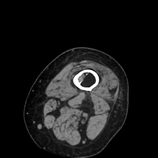 File:Chondrosarcoma - femur (Radiopaedia 64187-72954 Axial non-contrast 5).jpg