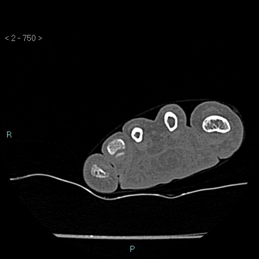 Chondrosarcoma - phalanx (Radiopaedia 69047-78812 Axial bone window 4).jpg