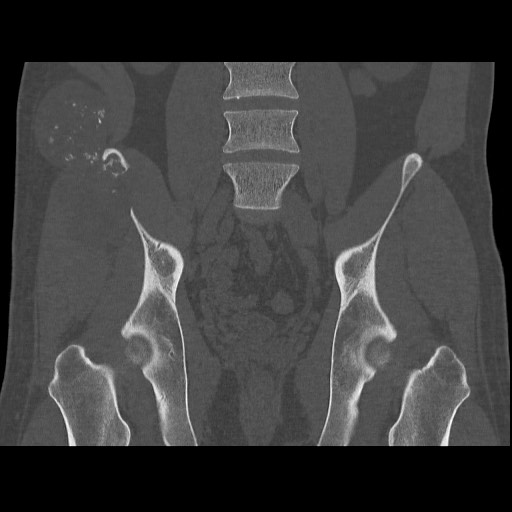 Chondrosarcoma of iliac wing (Radiopaedia 63861-72599 Coronal bone window 66).jpg