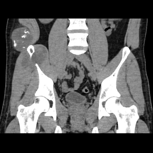File:Chondrosarcoma of iliac wing (Radiopaedia 63861-72599 Coronal non-contrast 61).jpg