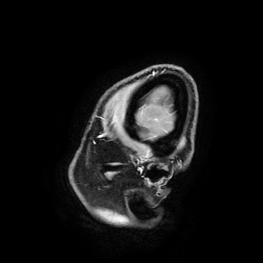Chordoid glioma of third ventricle (Radiopaedia 91612-109340 F 23).jpg