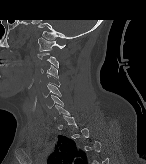 File:Chordoma (C4 vertebra) (Radiopaedia 47561-52188 Sagittal bone window 53).png