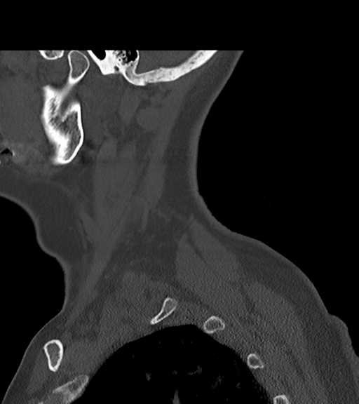 File:Chordoma (C4 vertebra) (Radiopaedia 47561-52188 Sagittal bone window 8).png