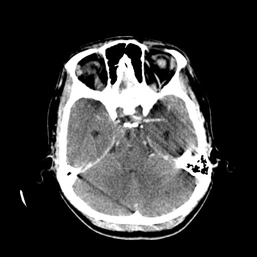 File:Choriocarcinoma of ovary with cerebral and pulmonary metastases (Radiopaedia 25983-26118 C+ arterial phase 48).jpg