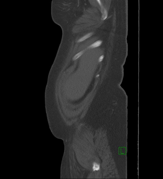 Chromophobe renal cell carcinoma (Radiopaedia 84239-99519 Sagittal bone window 100).jpg