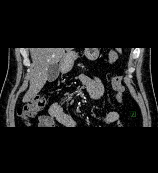 Chromophobe renal cell carcinoma (Radiopaedia 84286-99573 E 1).jpg