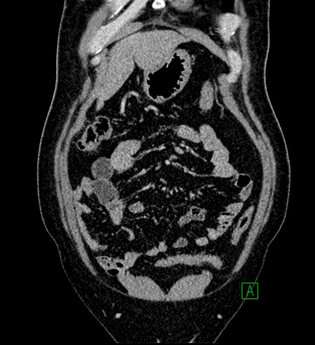 Chromophobe renal cell carcinoma (Radiopaedia 84286-99573 H 39).jpg