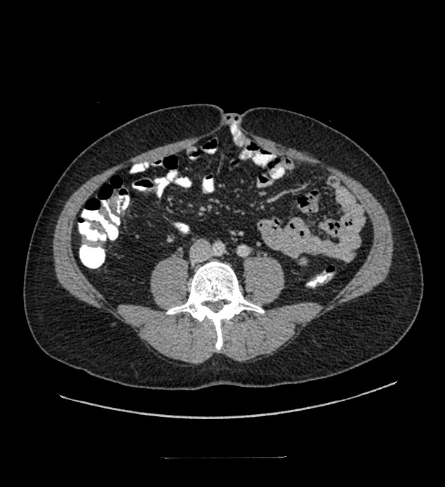 Chromophobe renal cell carcinoma (Radiopaedia 84337-99644 C 79).jpg