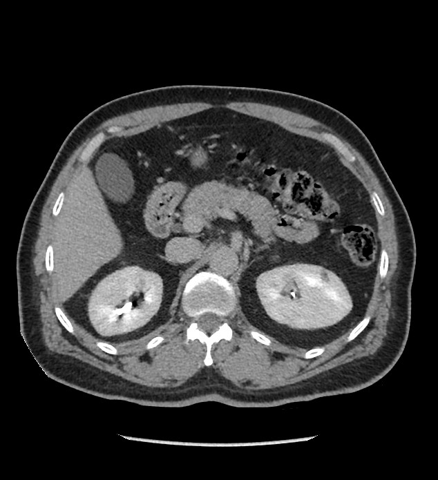 Chromophobe renal cell carcinoma (Radiopaedia 86879-103083 D 46).jpg
