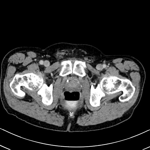 Chronic appendicitis complicated by appendicular abscess, pylephlebitis and liver abscess (Radiopaedia 54483-60700 B 146).jpg