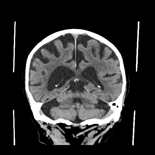Chronic bilateral subdural hygroma (Radiopaedia 85801-101622 Coronal non-contrast 54).jpg