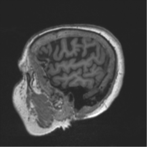 Chronic hypertensive encephalopathy (Radiopaedia 39993-42482 Sagittal T1 19).png