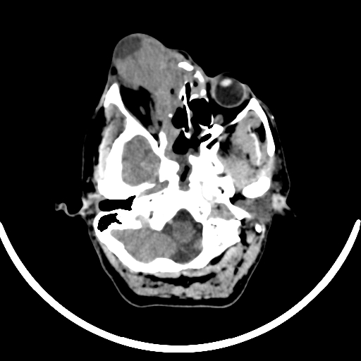 File:Chronic invasive fungal sinusitis with intraorbital and intracranial extension (Radiopaedia 56387-63046 Axial non-contrast 109).jpg