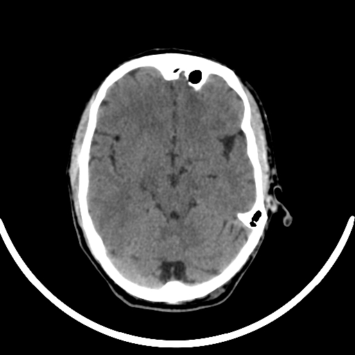 File:Chronic invasive fungal sinusitis with intraorbital and intracranial extension (Radiopaedia 56387-63046 Axial non-contrast 170).jpg