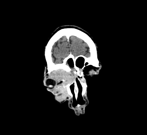 Chronic invasive fungal sinusitis with intraorbital and intracranial extension (Radiopaedia 56387-63046 C 55).jpg