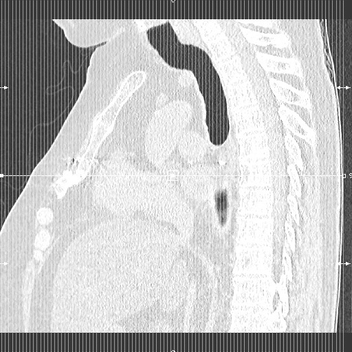 Chronic lung allograft dysfunction - restrictive form (Radiopaedia 60595-68316 Coronal lung window 1).jpg
