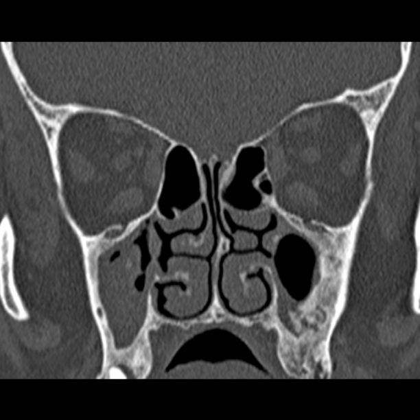 Chronic maxillary sinusitis (Radiopaedia 27879-28116 Coronal bone window 28).jpg