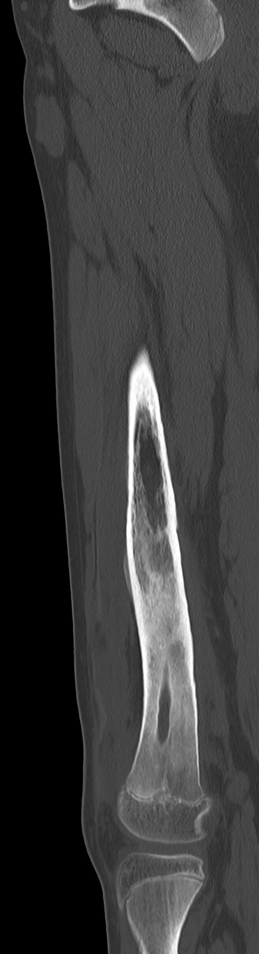Chronic ostemyelitis of the femur with long sinus tract (Radiopaedia 74947-85982 Sagittal bone window 49).jpg