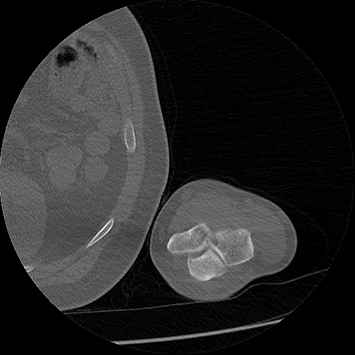 Chronic osteomyelitis (Radiopaedia 67597-76998 Axial bone window 70).jpg