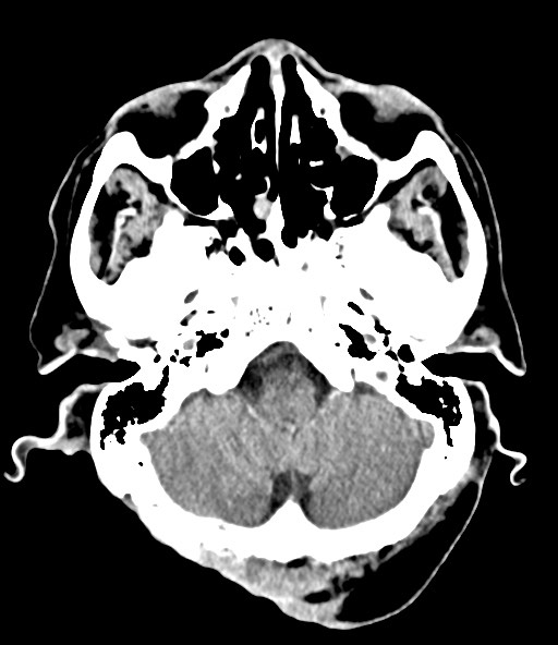 File:Chronic osteomyelitis - calvarial (severe) (Radiopaedia 69668-79616 Axial non-contrast 30).jpg