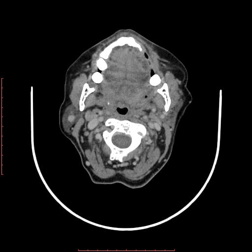 File:Chronic osteomyelitis - maxilla (Radiopaedia 23783-23927 B 46).jpg