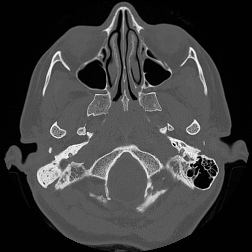 File:Chronic otomastoiditis (Radiopaedia 27138-27309 Axial bone window 6).jpg