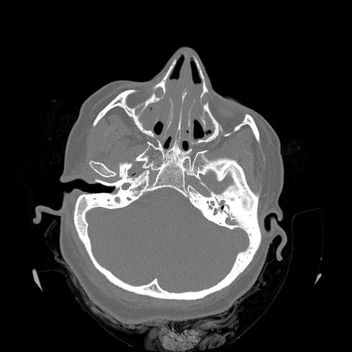 File:Chronic sinusitis with intra-sinus calcification (Radiopaedia 63919-72668 Axial bone window 39).jpg